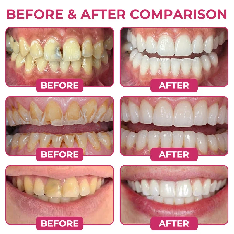 COUGEX® Cavity-Repair Natural Enamel Filling Gel