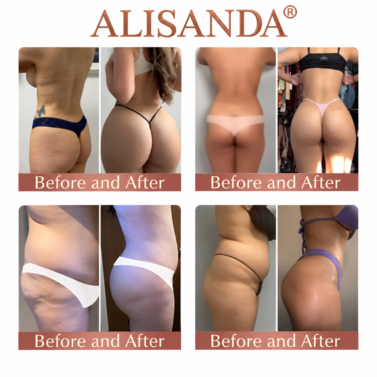 ALISANDA®  CurveSculpt Micro-Patch ✦ Sculpt • Firm • Smooth Lower Body Curves ✦ Micro-Needle Infusion System